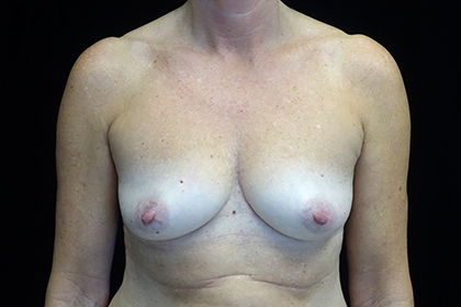 Breast Augmentation (Fat Transfer) Before & After Patient #17319