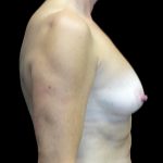 Breast Augmentation (Fat Transfer) Before & After Patient #17319