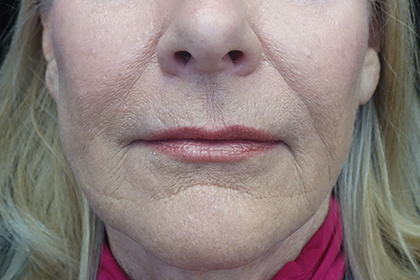 Fat Transfer to Face Before & After Patient #17267