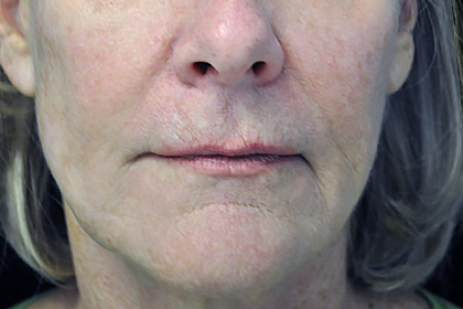 Fat Transfer to Face Before & After Patient #17267
