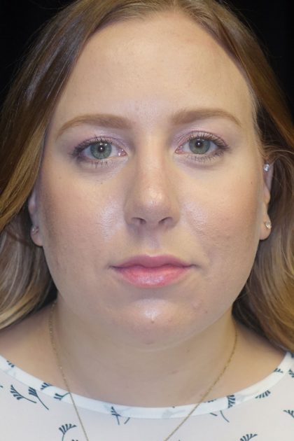 Rhinoplasty Before & After Patient #17409