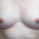 Nipple Inversion Before & After Patient #17270