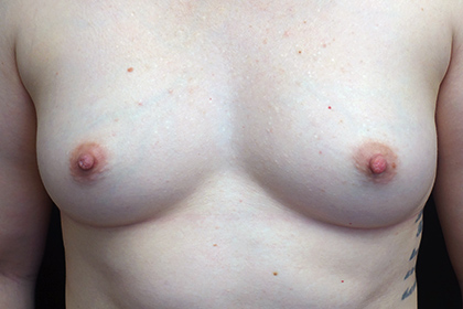 Nipple Inversion Before & After Patient #17270