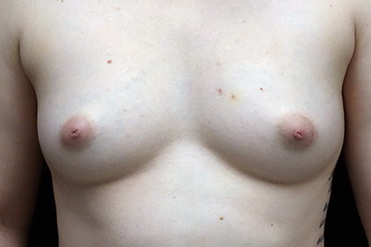 Nipple Inversion Before & After Patient #17270