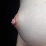Nipple Inversion Before & After Patient #17270