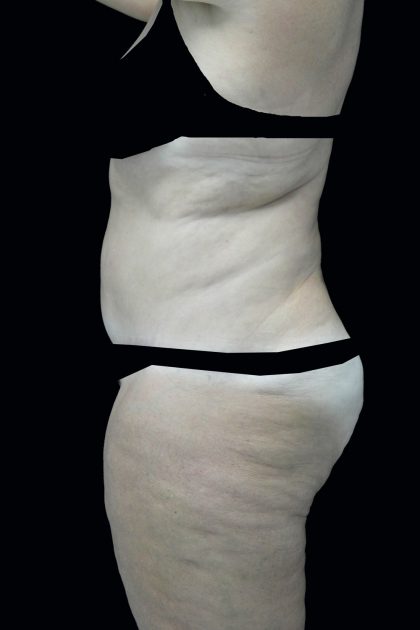 Lipoabdominoplasty Before & After Patient #17368