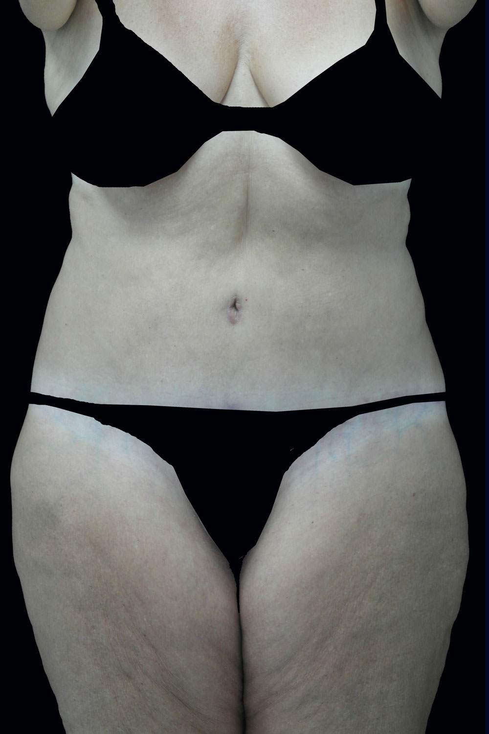 Lipoabdominoplasty Before & After Patient #17368
