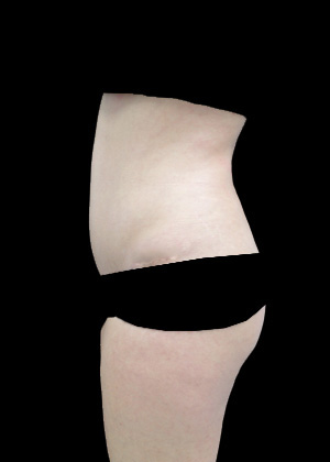 Lipoabdominoplasty Before & After Patient #17326