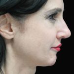 Rhinoplasty Before & After Patient #17335