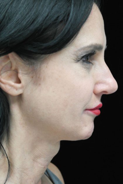 Rhinoplasty Before & After Patient #17335