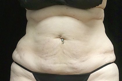 Patient #17192 CoolSculpting Before and After Photos Pittsburgh, PA - Plastic  Surgery Gallery Dr. Anna Wooten