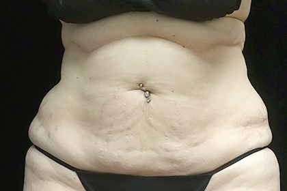 CoolSculpting Before & After Patient #17192