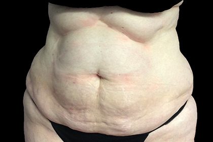 CoolSculpting Before & After Patient #17192