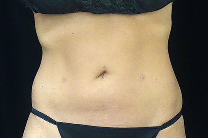 CoolSculpting Before & After Patient #17264