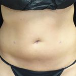 CoolSculpting Before & After Patient #17264