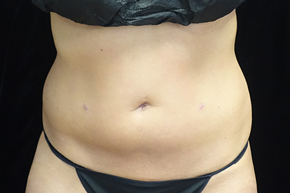 CoolSculpting Before & After Patient #17264