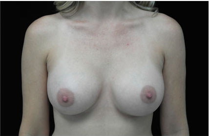 Breast Augmentation (Implants) Before & After Patient #17215