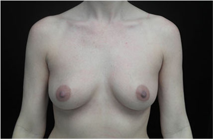 Breast Augmentation (Implants) Before & After Patient #17215