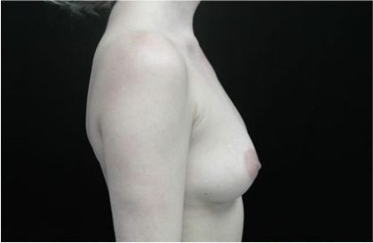 Breast Augmentation (Implants) Before & After Patient #17215