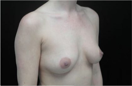 Breast Augmentation (Implants) Before & After Patient #17215