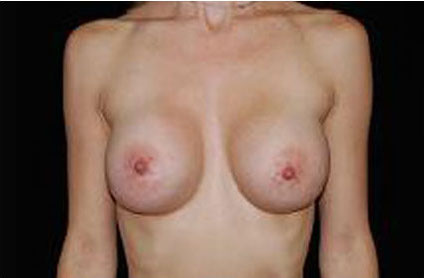 Breast Augmentation (Implants) Before & After Patient #17222