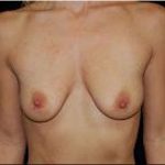 Breast Augmentation (Implants) Before & After Patient #17222