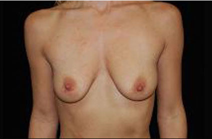 Breast Augmentation (Implants) Before & After Patient #17222