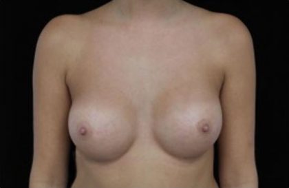 Breast Augmentation (Implants) Before & After Patient #17229