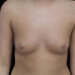 Breast Augmentation (Implants) Before & After Patient #17229