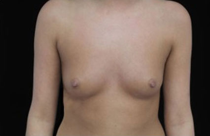 Breast Augmentation (Implants) Before & After Patient #17229
