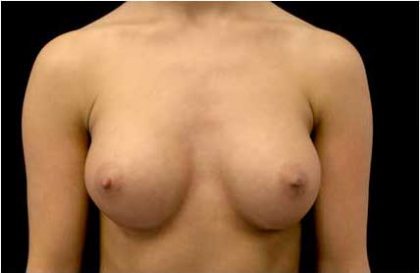 Breast Augmentation (Implants) Before & After Patient #17236