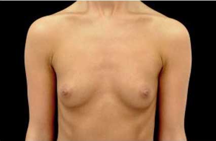 Breast Augmentation (Implants) Before & After Patient #17236