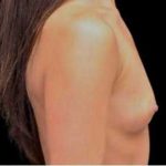 Breast Augmentation (Implants) Before & After Patient #17236