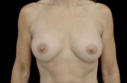Breast Augmentation (Implants) Before & After Patient #17243