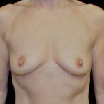 Breast Augmentation (Implants) Before & After Patient #17243