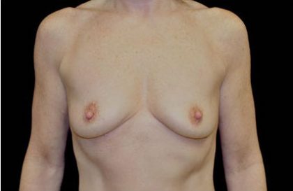 Breast Augmentation (Implants) Before & After Patient #17243