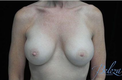 Breast Augmentation (Implants) Before & After Patient #17250