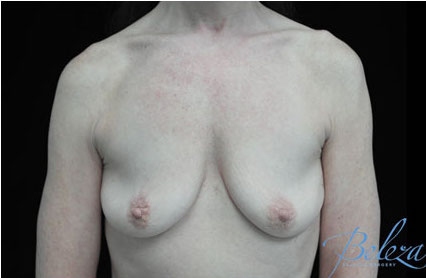 Breast Augmentation (Implants) Before & After Patient #17250