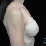 Breast Augmentation (Implants) Before & After Patient #17250