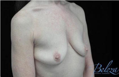Breast Augmentation (Implants) Before & After Patient #17250
