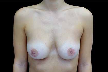 Breast Reduction Before & After Patient #17312