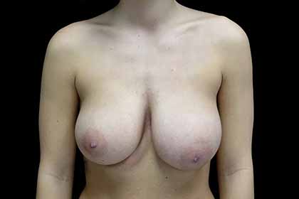 Breast Reduction Before & After Patient #17312