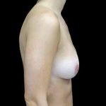 Breast Reduction Before & After Patient #17312