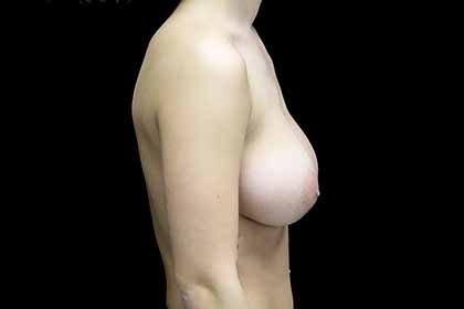 Breast Reduction Before & After Patient #17312