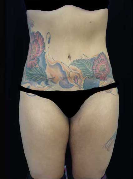 Lipoabdominoplasty Before & After Patient #17446