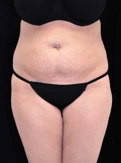Lipoabdominoplasty Before & After Patient #17446