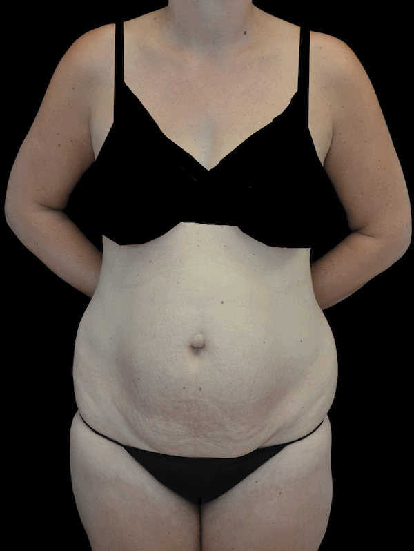 Lipoabdominoplasty Before & After Patient #17546