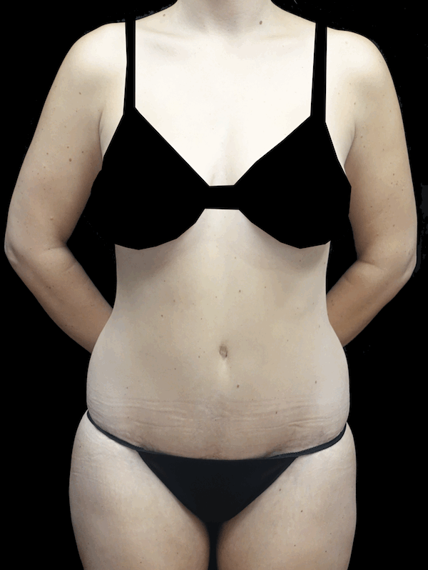 Lipoabdominoplasty Before & After Patient #17546