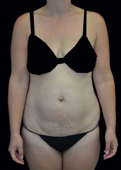 Lipoabdominoplasty Before & After Patient #17546