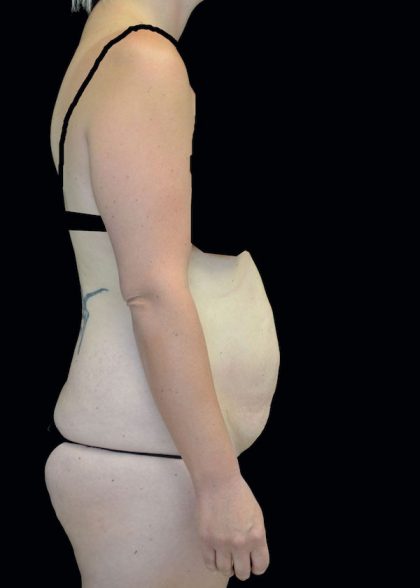 Lipoabdominoplasty Before & After Patient #17546
